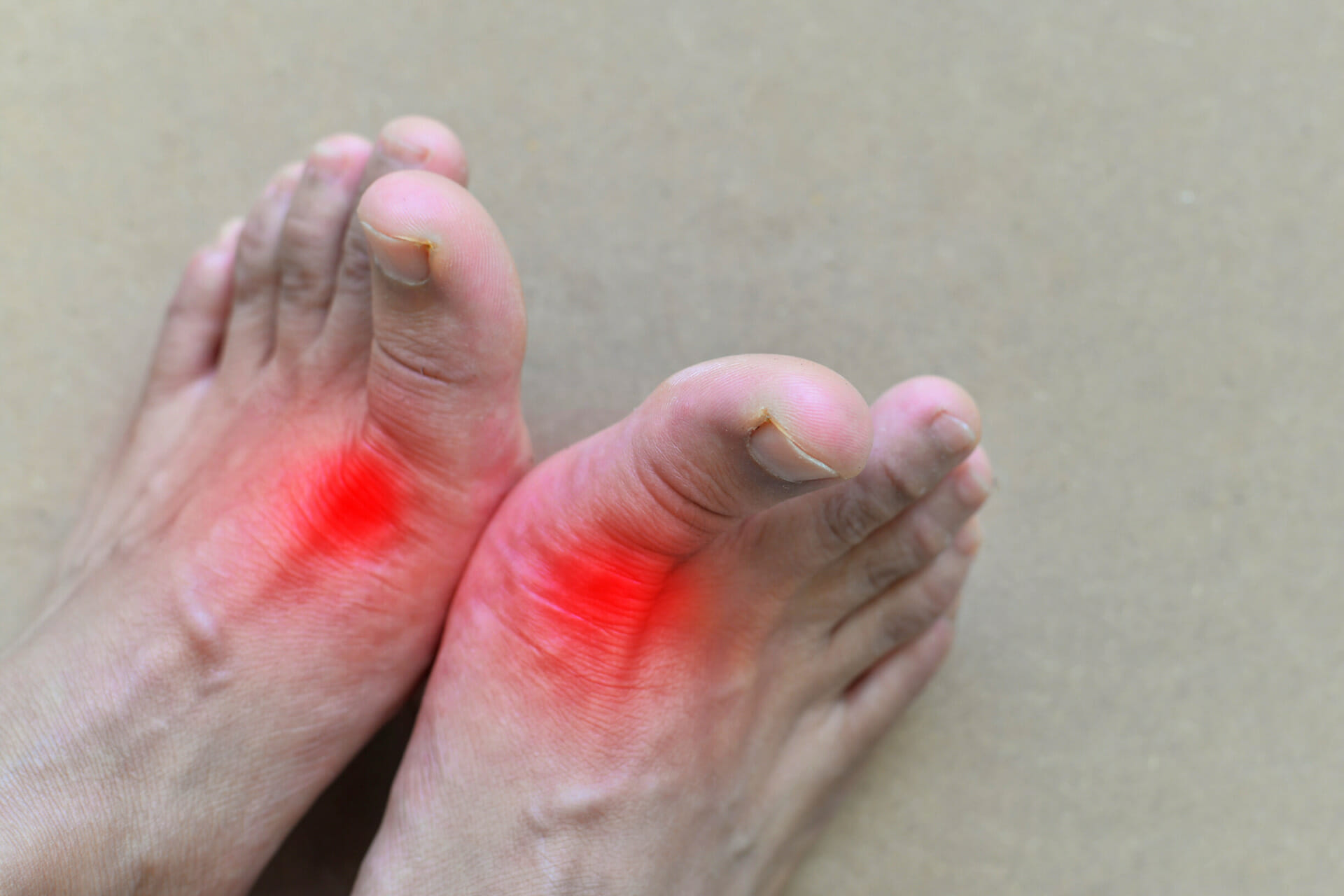 Chronic Kidney Disease and Gout Understanding the Connection